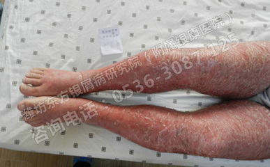 春季银屑病预防 远离复发困扰的健康指南