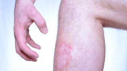 银屑病预防全指南 科学管理，远离“牛皮癣”困扰