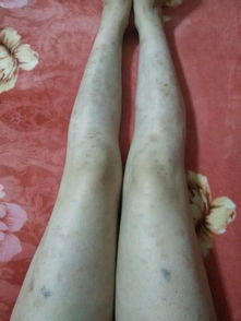 醋疗与银屑病反复复发的预防探讨