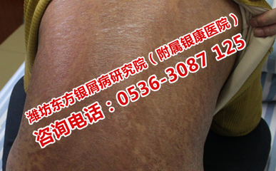 银屑病冬季护理计划与预防咨询