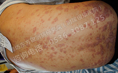 银屑病患者春季防感冒，守护皮肤健康