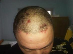 头部牛皮癣的具体原因与预防咨询