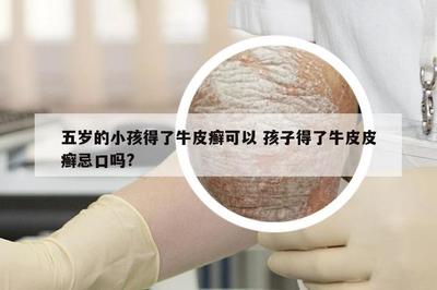 五岁儿童银屑病（牛皮癣）的饮食禁忌与预防策略