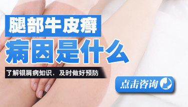 探析银屑病（牛皮癣）的成因与科学预防指南