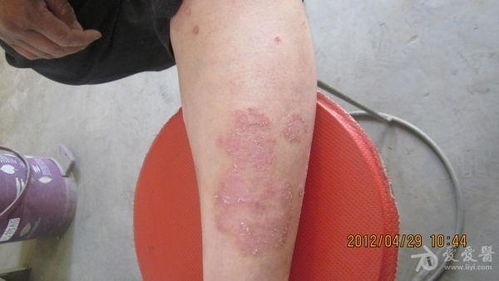 科学认识银屑病 从典型皮损到全面预防策略