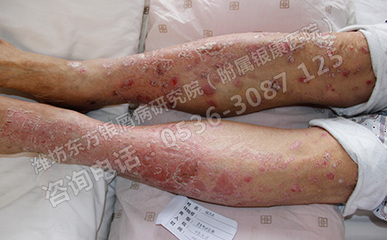 夏日护“肤”攻略 银屑病患者的科学护理与预防指南